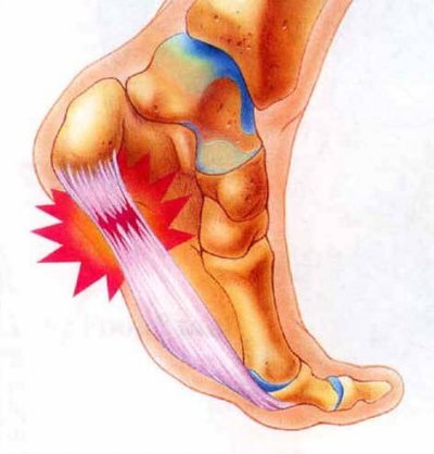 Plantar Fasciitis1