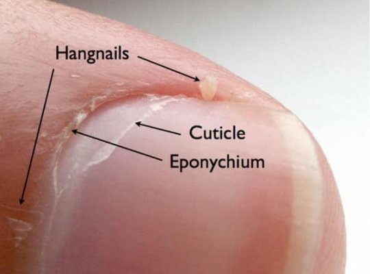 Hangnail explanation